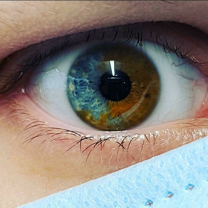 Close-up of eye showing rare heterochromia with blue and brown colors