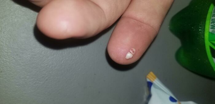 Finger with a rare small tooth-like growth on the tip