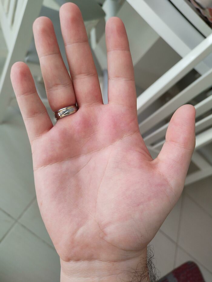 Hand with six fingers showing rare physical feature