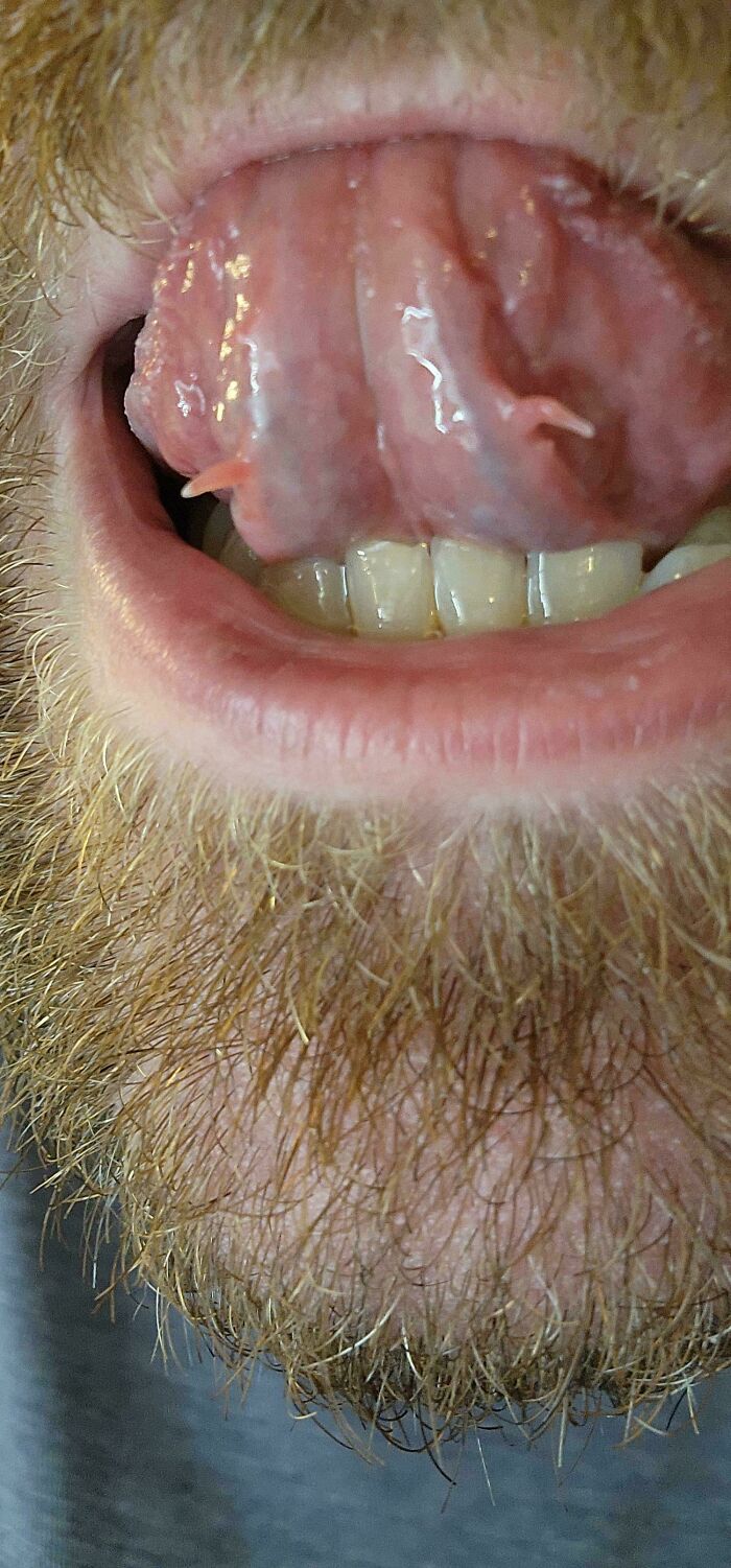 Tongue with rare bifurcated tips showing unusual physical feature