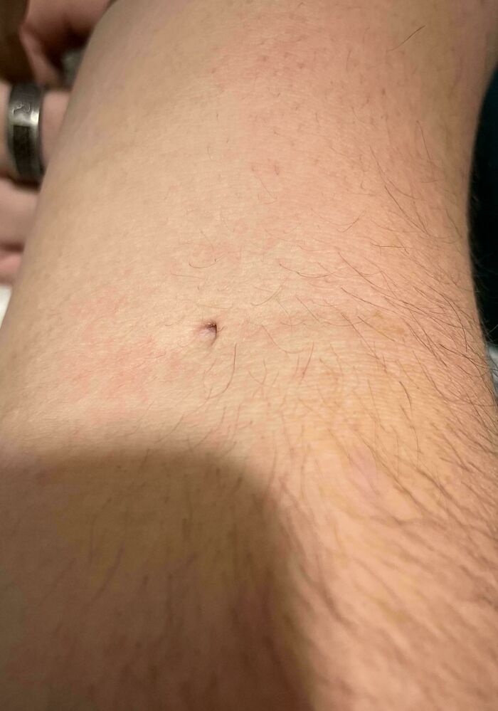 Rare physical feature showing unusual belly button shape on skin