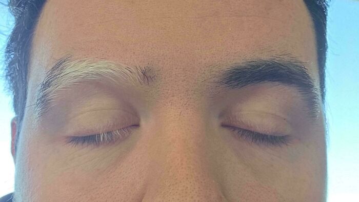 Rare physical feature showing different eyebrow colors on closed eyes