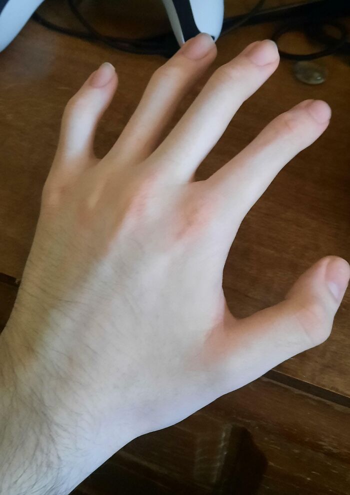 Hand with unique finger spacing and shape highlighting rare physical feature