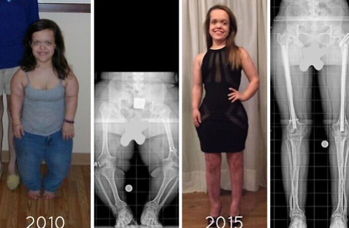 Before and after photo of a woman with dwarfism and her x-rays from 2010 and 2015, highlighting her inspiring transformations.