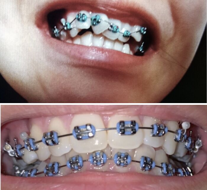 Before and after photos showing surprising transformations of teeth with braces.