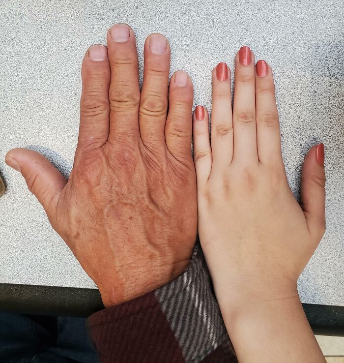 Comparison of two hands showing rare physical feature differences