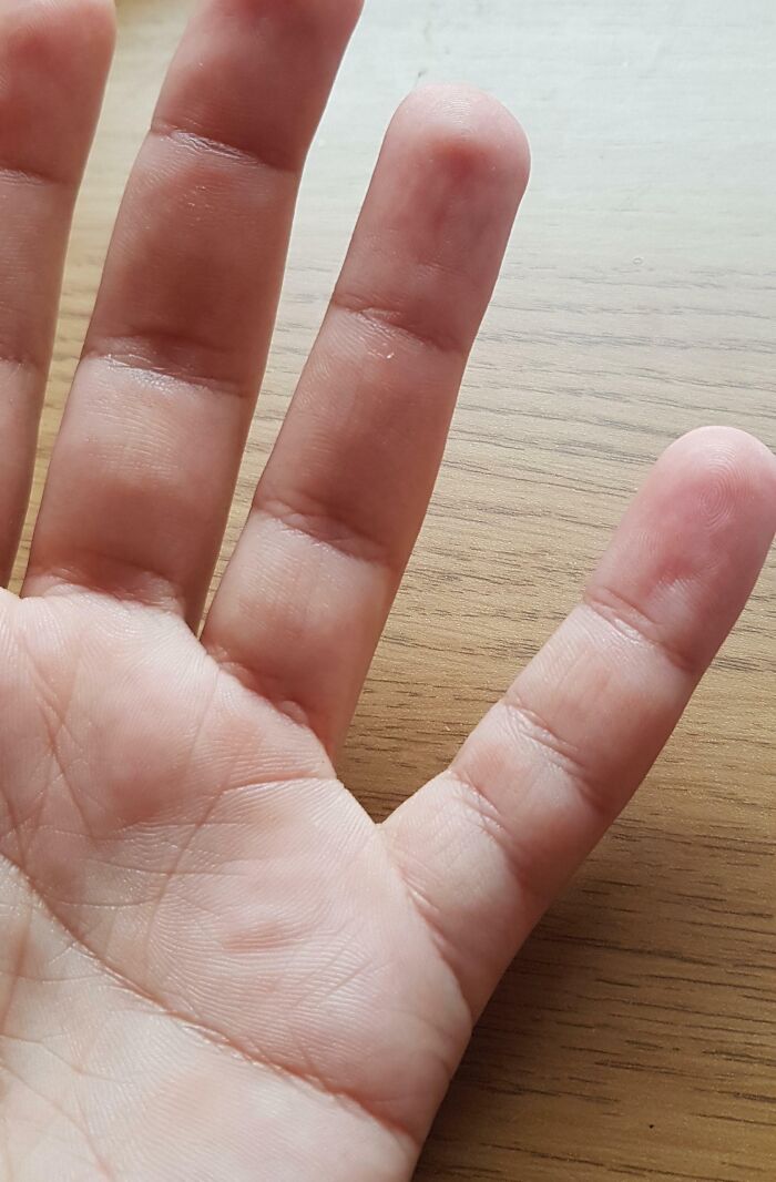 Hand with fingers showing unusual smooth skin texture