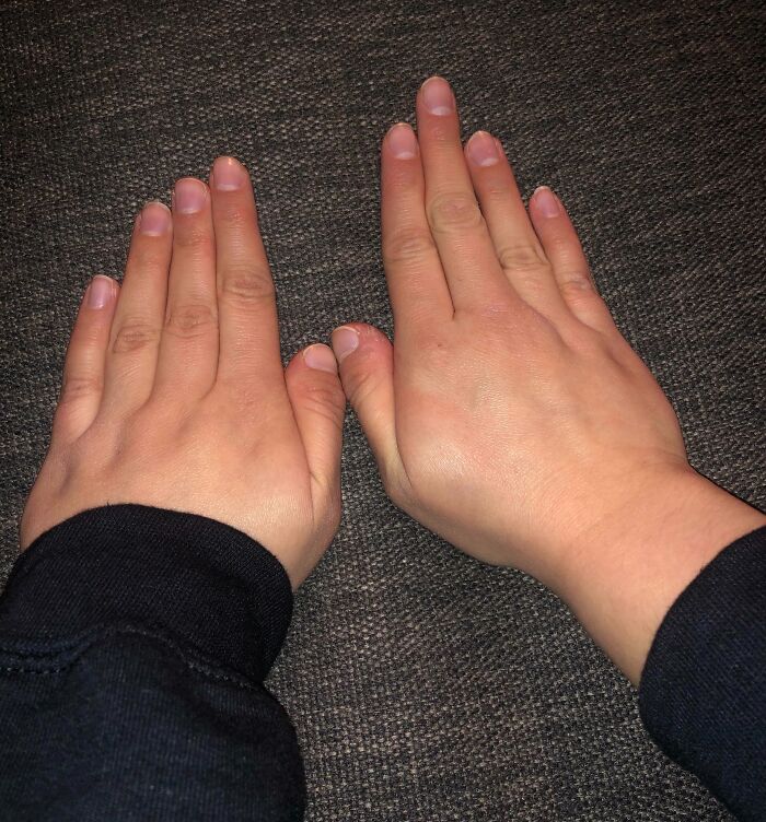Hands with rare physical features showing thumb deformation