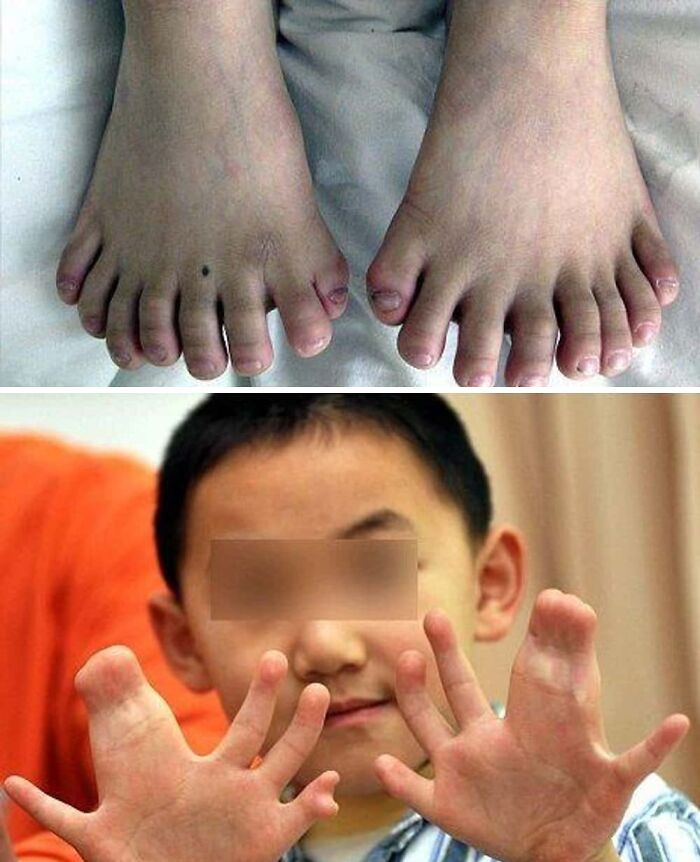 Child showing hands and feet with rare physical deformities