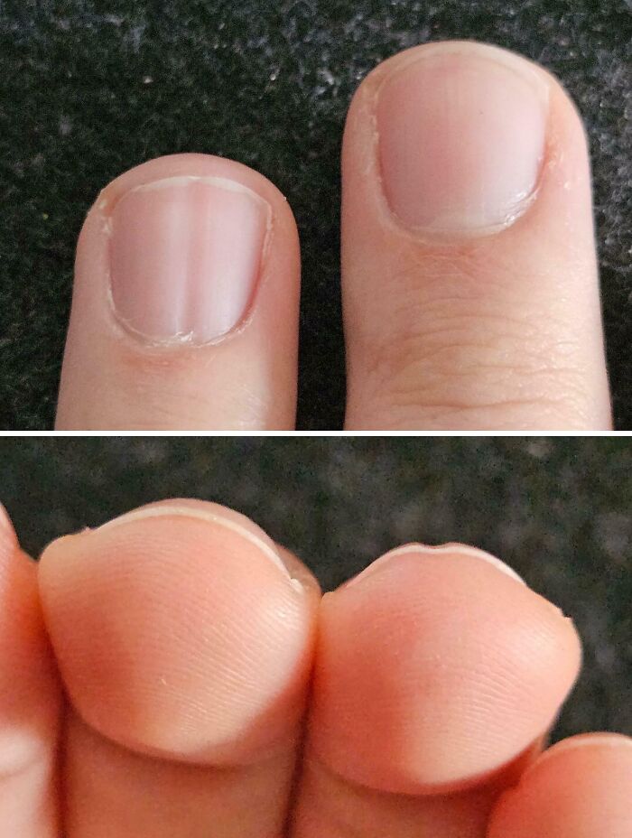 Unusual physical feature of human fingers and nails close up