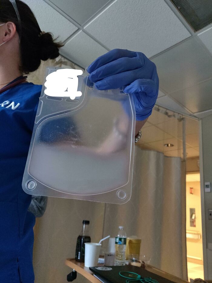 Nurse holding a bag of cloudy plasma, showing interesting and cool photos of medical phenomena.