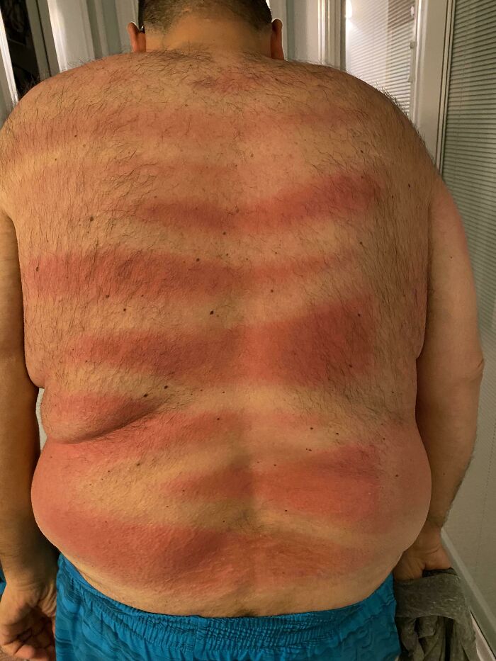 Man's back with funny, uneven striped sunburn lines, showing the ridiculous things wives do while applying sunscreen.