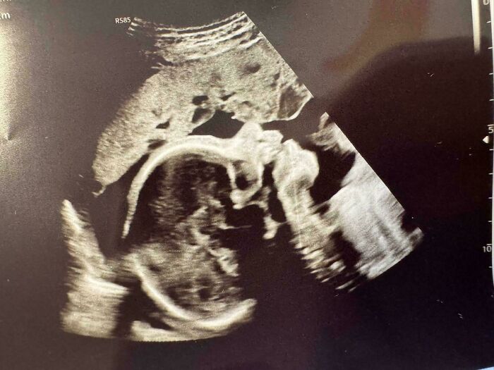 An ultrasound scan image showing a baby, celebrating the journey of wholesome dads during pregnancy.