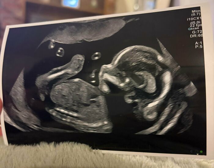 An ultrasound scan image showcasing a growing baby during pregnancy.