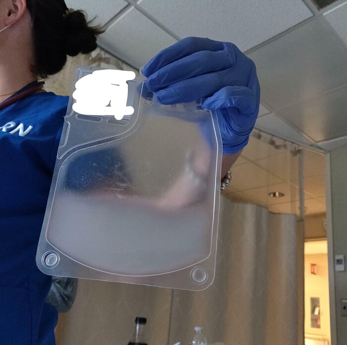 Nurse holding a bag of cloudy plasma, showing interesting and cool photos of medical phenomena.