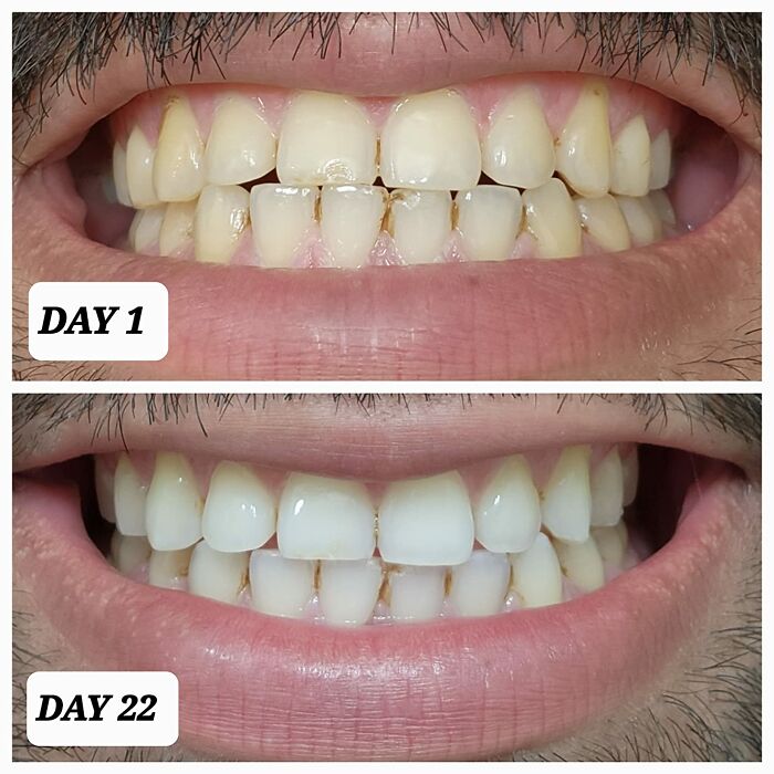 Before and after close-up of teeth whitening results, a top deal from Prime Big Deal Days