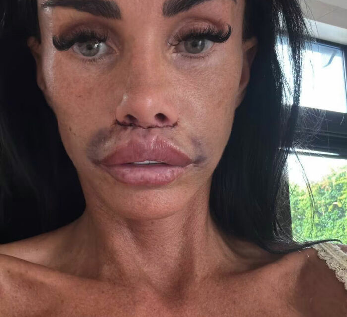 Close-up of Katie Price after corrective surgery, showing bruising and swelling around her mouth and nose. Close-up of Katie Price after corrective surgery, showing bruising and swelling around her mouth and nose.