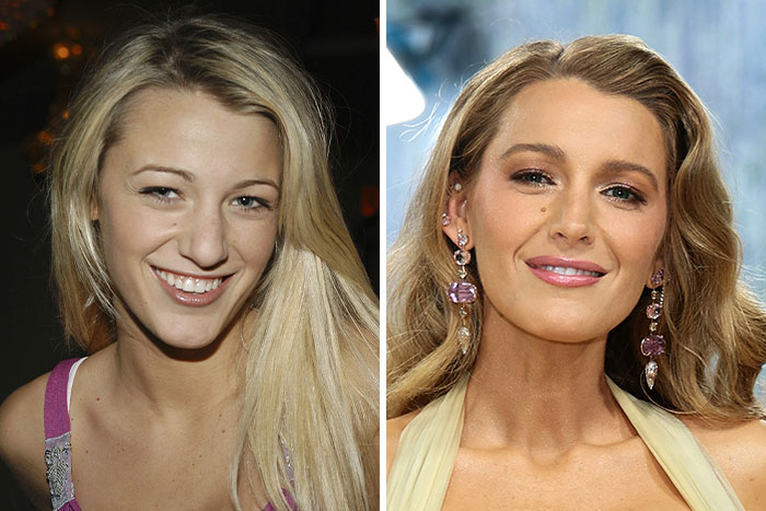 Blake Lively's looksmaxxing journey and how her appearance has changed, with insights into possible procedures.