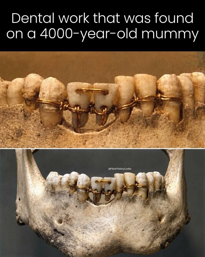 Ancient dental work on a 4000-year-old mummy, showcasing fascinating photos from history.