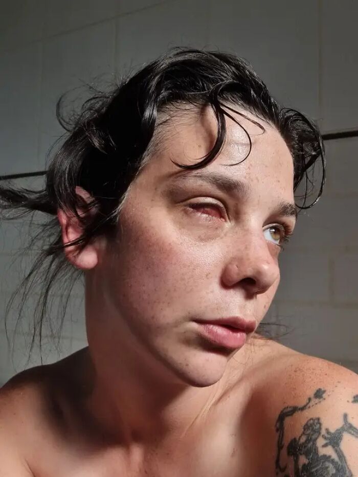 A woman with an artificial prosthetic eye after losing her eye due to a tumor
