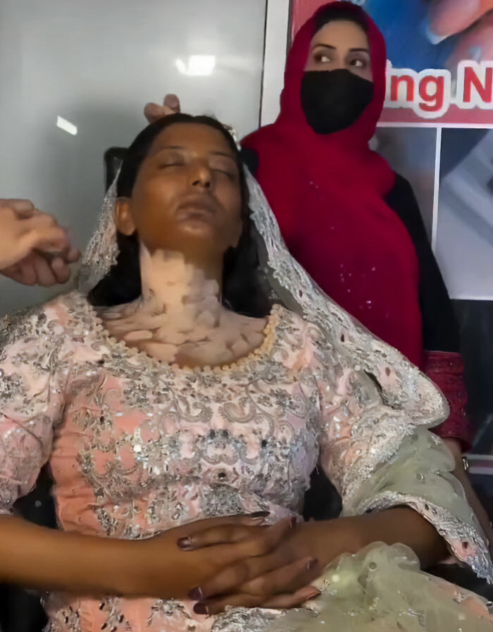 A woman with vitiligo receiving wedding day makeup for a dramatic transformation. A woman with vitiligo receiving wedding day makeup for a dramatic transformation.