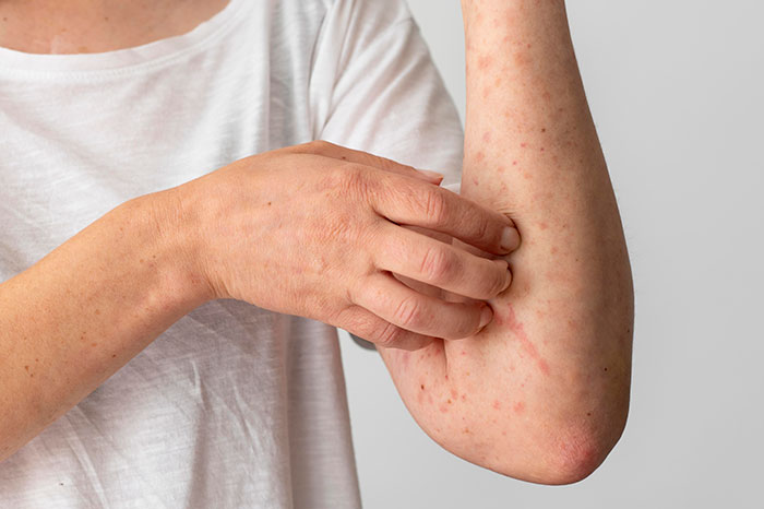 A woman with an allergy scratching her arm, showing red inflamed skin and rashes. Her husband pressures her to rake.