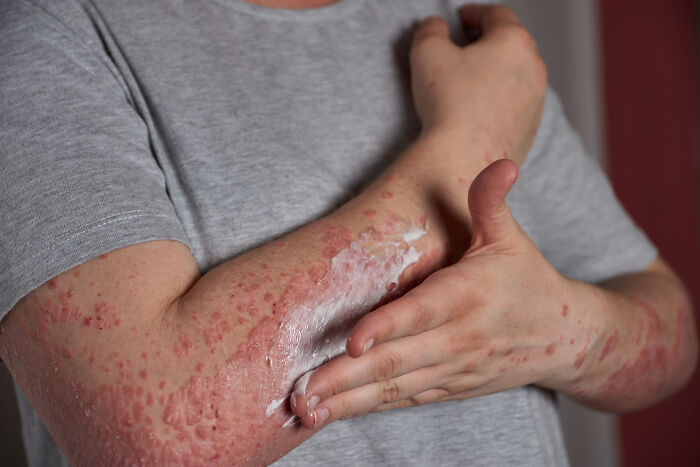 A person applies cream to their arm covered in red, irritated skin, indicating a severe skin condition and sickness.