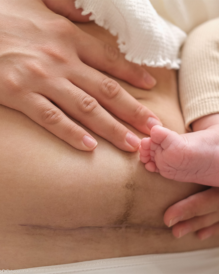 A close-up of a mother's hand on her abdomen with a C-section scar, alongside a baby's tiny foot, symbolizing recent childbirth. A close-up of a mother's hand on her abdomen with a C-section scar, alongside a baby's tiny foot, symbolizing recent childbirth.