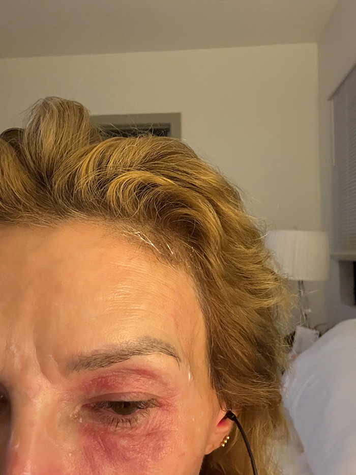 &lsquo;Embarrassed&rsquo; Brandi Glanville Breaks Down Over Asking Fans For Money Amid Ongoing Facial Disfigurement