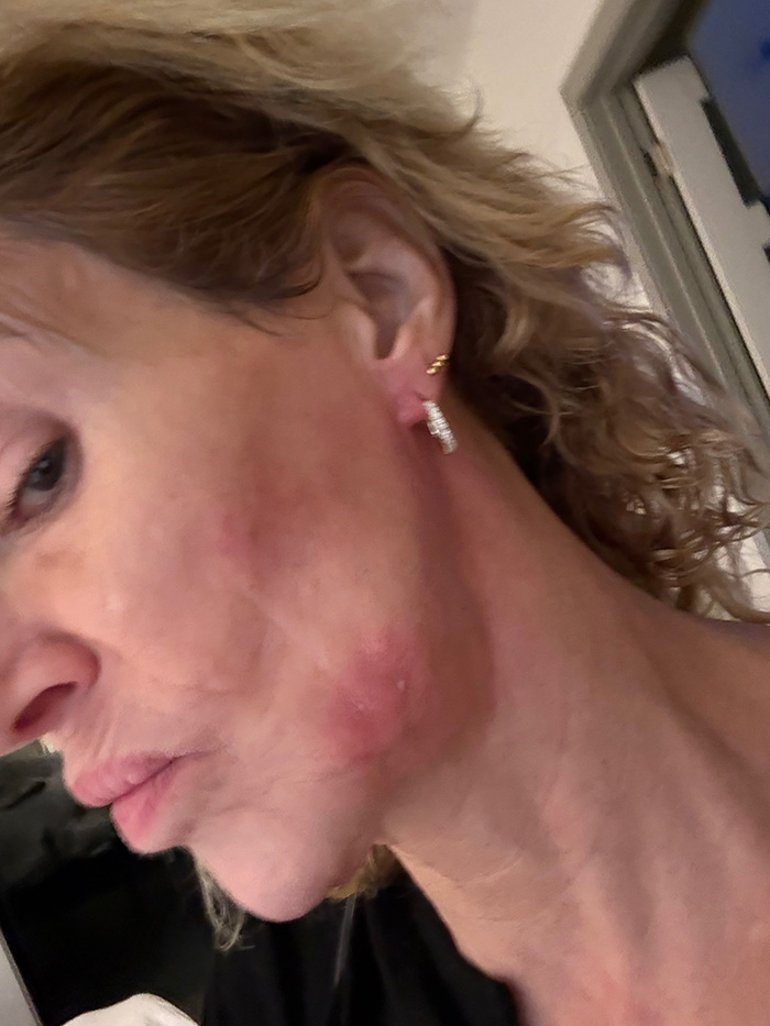 &lsquo;Embarrassed&rsquo; Brandi Glanville Breaks Down Over Asking Fans For Money Amid Ongoing Facial Disfigurement