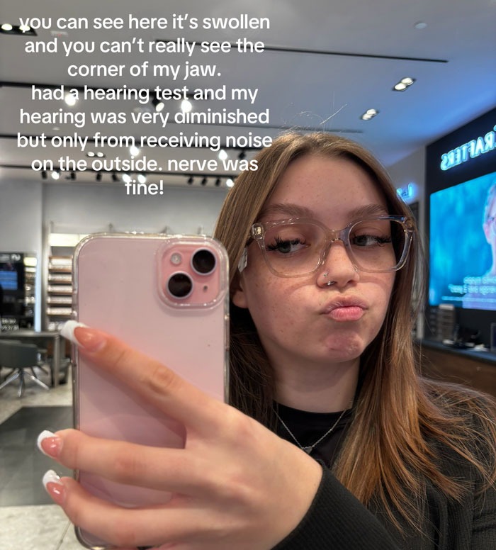Young woman takes a selfie, showing her swollen jaw, wearing glasses, related to rare cancer and ears won't pop. Young woman takes a selfie, showing her swollen jaw, wearing glasses, related to rare cancer and ears won't pop.