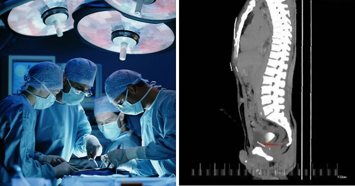 Doctors Make Damning Discovery Of ‘Foreign Bodies’ In Man’s Chest, Pelvis, Bladder And Private Parts At Chinese Hospital