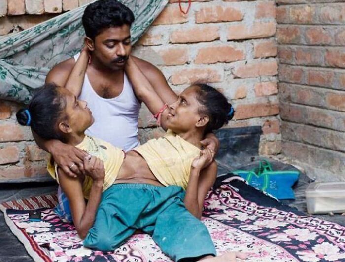 Man holding conjoined twins with rare physical body features