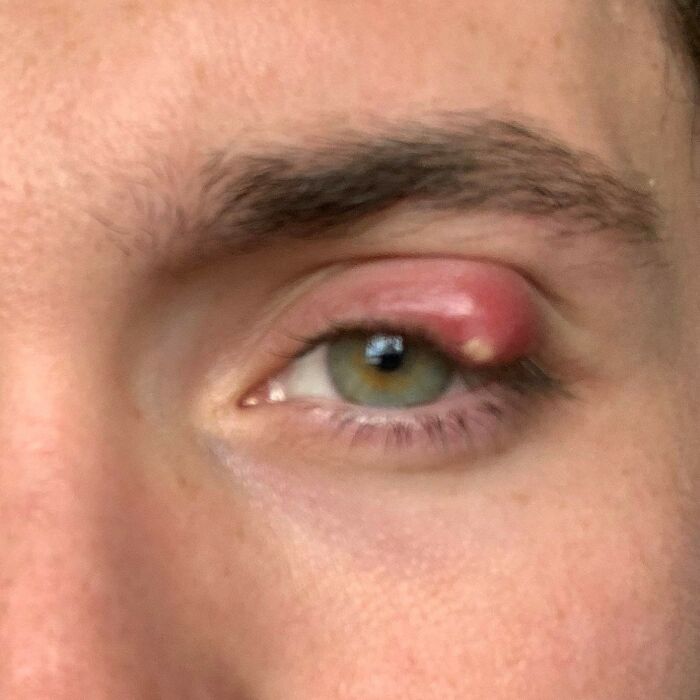A client's eye with a large stye, showcasing a potentially stupid medical choice.