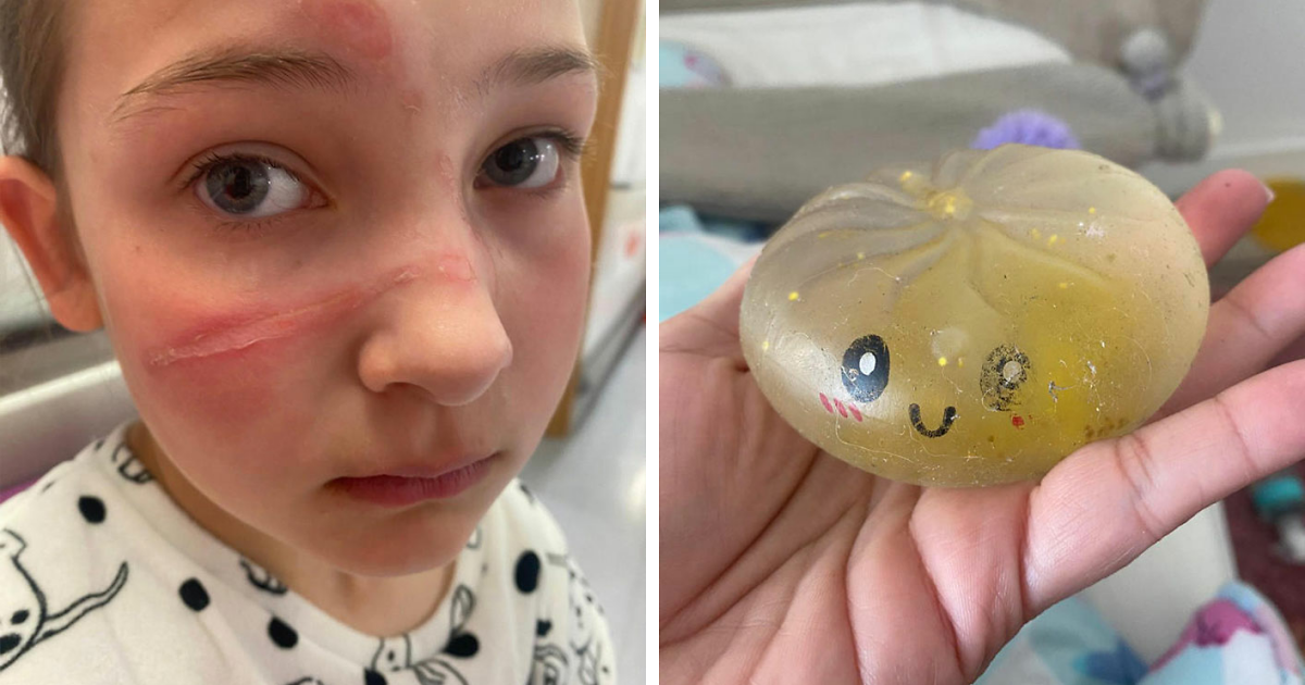 Popular Squishy Toys Pulled From Market After Children Are Hospitalized With Serious Injuries