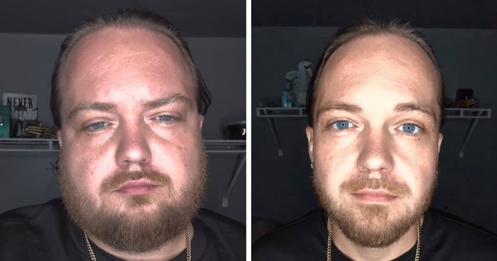 Before and after headshots of a man showing his facial weight loss transformation, with a noticeable difference in his jawline. Before and after headshots of a man showing his facial weight loss transformation, with a noticeable difference in his jawline.