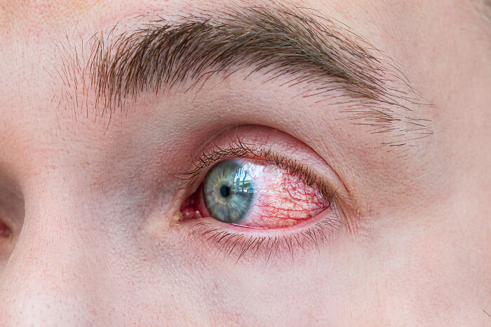 A close-up of a person's red, bloodshot eye, indicative of extreme illness and sickness.
