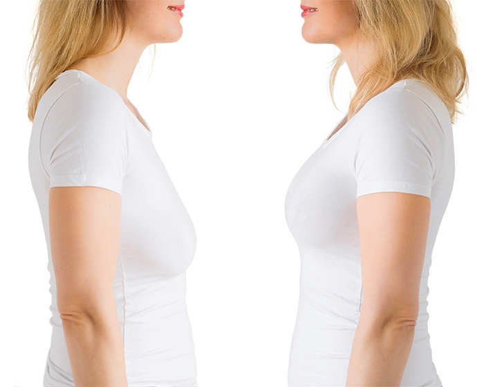 Before and after comparison of breast shape, highlighting the ideal breast shape from a new study.