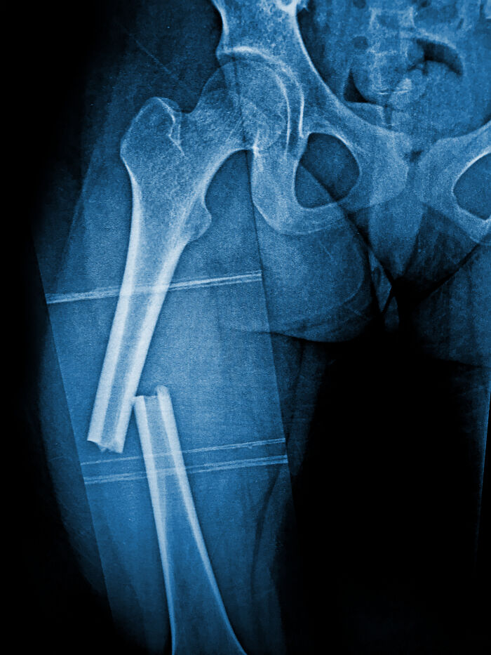 An X-ray of a broken femur, illustrating the pain reaction from a severe injury.