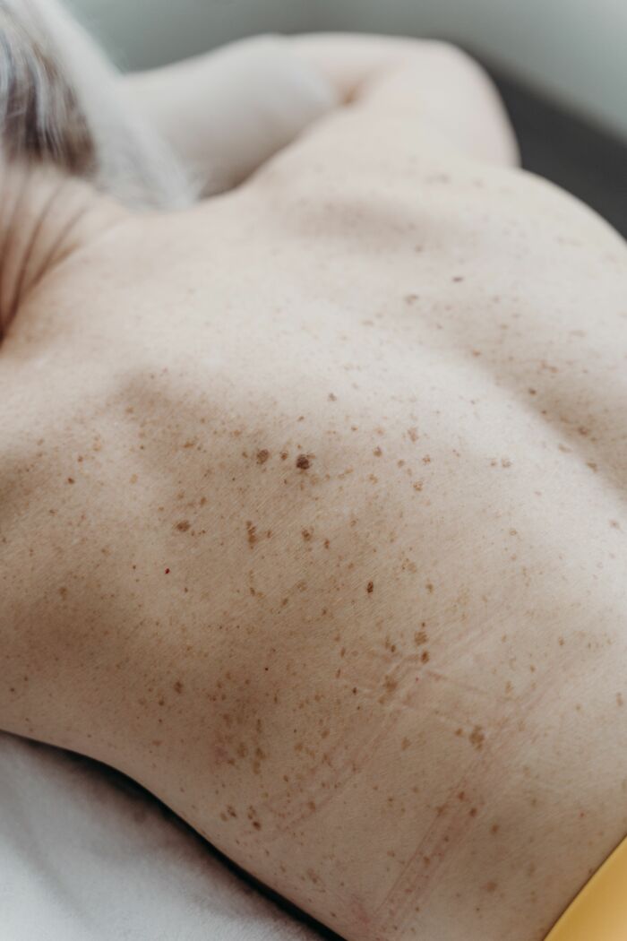 A persons back with moles, highlighting a health symptom that terrifies doctors.