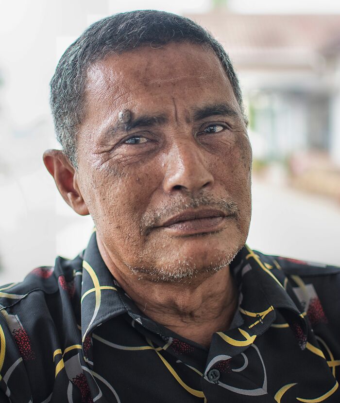 Man with a facial growth, illustrating health symptoms that may concern doctors.
