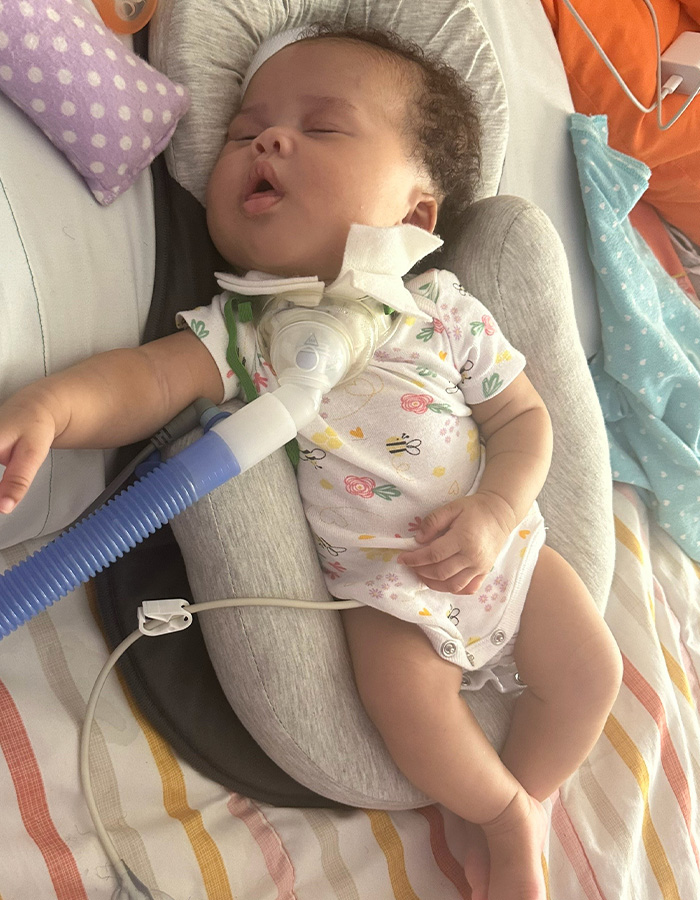 A sleeping baby breathing with medical equipment at home after a pregnant woman's routine scan diagnosis. A sleeping baby breathing with medical equipment at home after a pregnant woman's routine scan diagnosis.