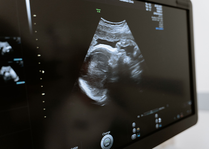 Ultrasound of a baby, related to a surrogate refusing to end pregnancy. Ultrasound of a baby, related to a surrogate refusing to end pregnancy.