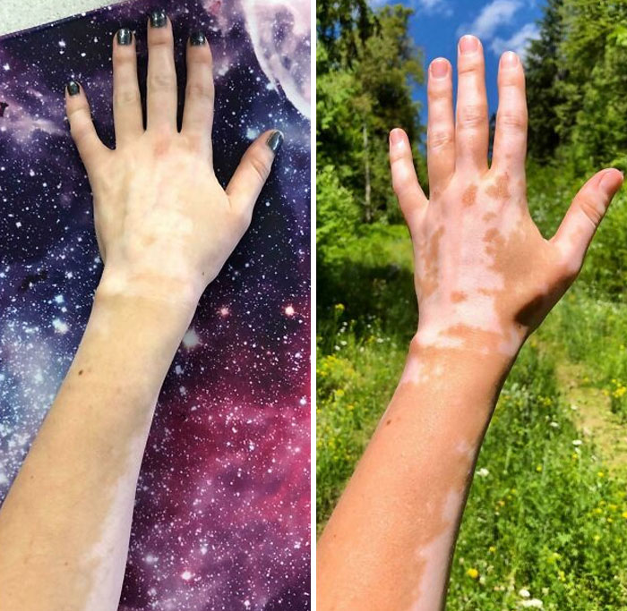 A hand showing vitiligo on a galaxy background and outdoors, displaying a rare body quirk.