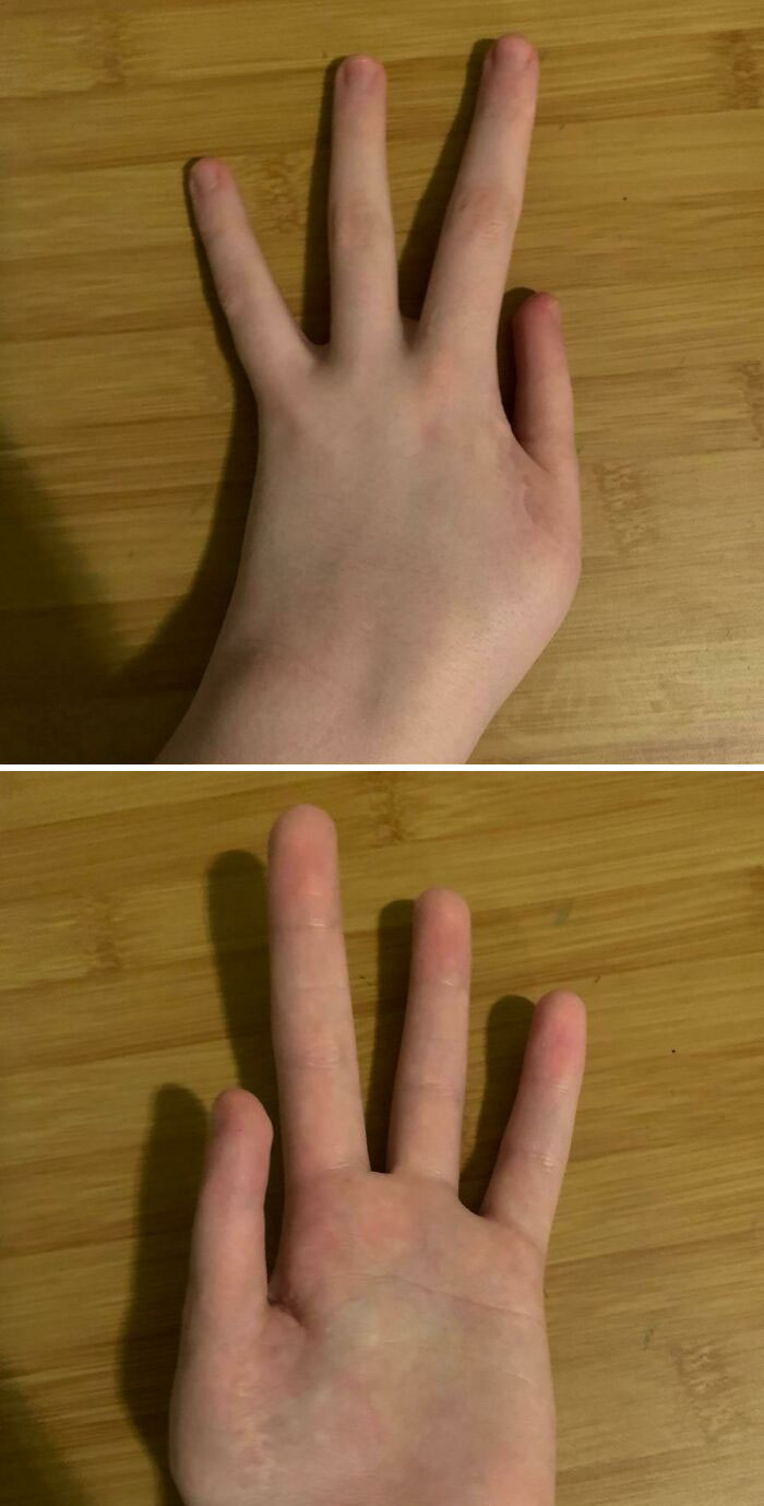 An image displaying a hand with a unique body quirk, highlighting an unusual finger position.