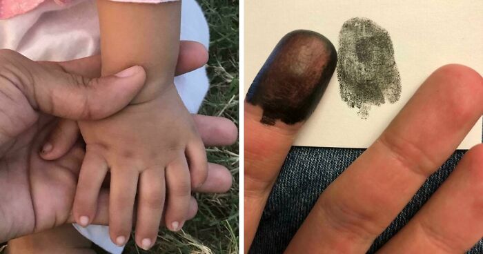 “40 Years Of Hiding These”: 85 Rare And Unexpected Body Quirks That Left People Fascinated