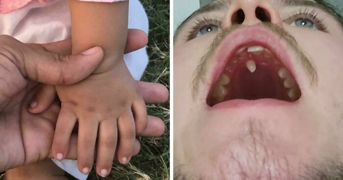 “40 Years Of Hiding These”: 85 Rare And Unexpected Body Quirks That Left People Fascinated