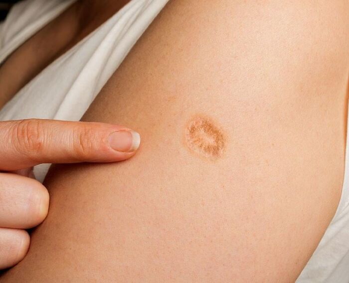 Lots Of People Have This Circular Scar, And Some Are Only Just Finding Out The Reason Behind It Lots Of People Have This Circular Scar, And Some Are Only Just Finding Out The Reason Behind It