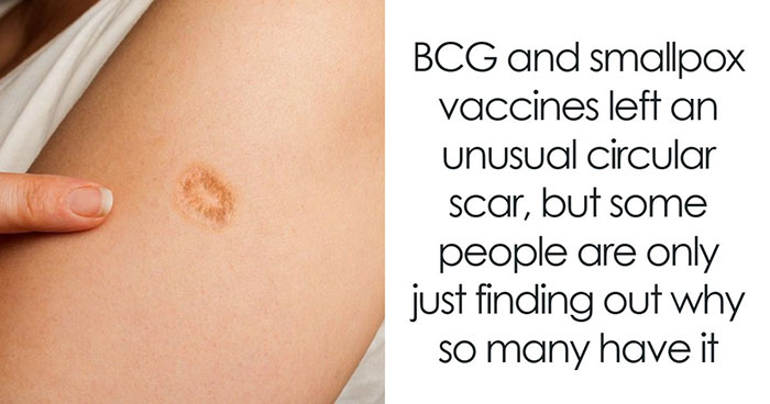 Same Scar On Many People Is Sparking Confusion Online, But Here’s Why So Many Have It
