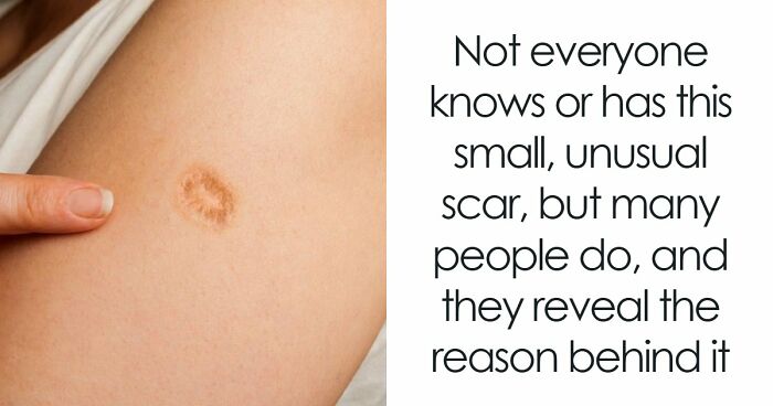 Same Scar On Many People Is Sparking Confusion Online, But Here’s Why So Many Have It